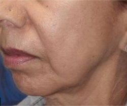 Secret RF Before & After Patient #1617